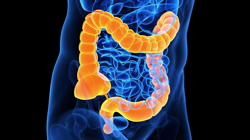 GI/Colorectal Cancer | Medscape