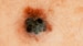 Melanoma Mortality Rates Fell in 2010s as New Therapies Took Hold
