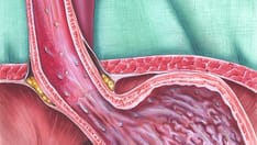 Fast Five Quiz: Gastroesophageal Reflux Disease Practice Essentials