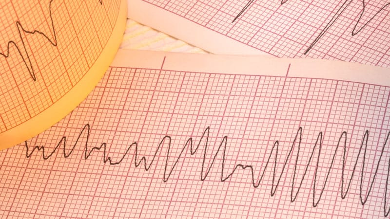 Dapagliflozin in HFrEF May Cut Arrhythmias, Sudden Death: DAPA-HF