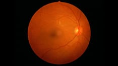 Common Eye Diseases Linked to Higher Risk for Dementia