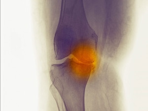 High Comorbidity Rate Seen Before Osteoarthritis Diagnosis