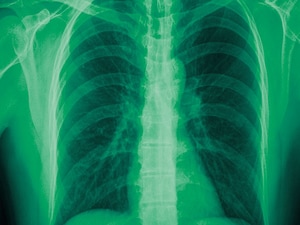 Biomarker-Guided Steroid Therapy Shown Safe for COPD