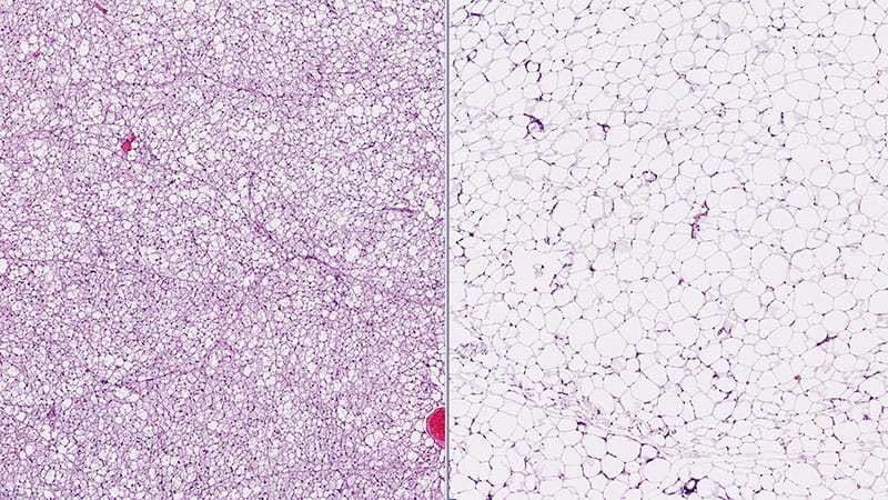 Brown Fat, White Fat. Is One Better Than the Other?