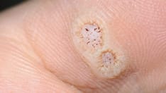 Study Evaluates Outcomes of Warts in Children on Cancer Treatments