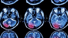 Diener's Top Studies From the 2023 International Stroke Conference