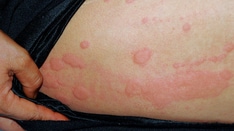 Chronic Urticaria During Pregnancy: Study Analyzes Outcomes, Treatments