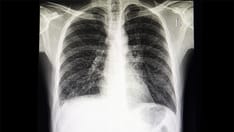 Nontuberculous Mycobacterial Lung Disease Can Be Challenging to Treat