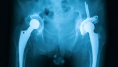 Rapid MRSA and S aureus Decolonization Beneficial for Emergency Hip Surgery