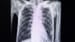 Race-Specific Spirometry May Miss Emphysema Diagnoses