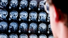 Type of AF Among Predictors of DOAC Overdosing, Underdosing