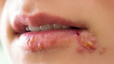 Fast Five Quiz: Herpes Simplex Virus