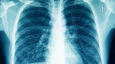 Conditional Recommendations Rule in New SARD-Associated Interstitial Lung Disease Guidelines