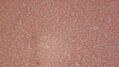 Finerenone Signals Pneumonia, COVID-19 Benefits