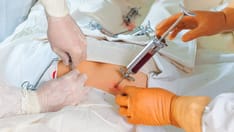 Stem Cell Transplantation 'Substantially' Superior to Fingolimod in Cutting RRMS Relapse Risk 