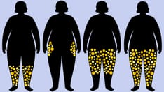 Lipedema: A Not-Uncommon Disease Still Goes Unrecognized