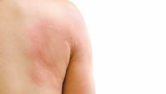 Doctors Can Combat Urticaria Misinformation With Empathy and Facts