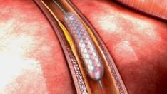 After PCI, 1-Month Beats 12-Month DAPT inHigh-Risk Patients