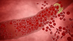 Inside the Big Business of Clogged Arteries