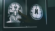 Tirofiban Superior to Aspirin in Stroke Without Large Occlusion