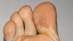 Cidofovir dosing, indications, interactions, adverse effects, and more