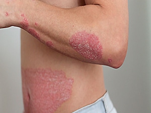 Nearly 1 in 3 Patients With IBD Affected by Skin Lesions