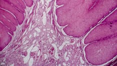 Fast Five Quiz: Genital Warts