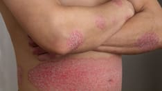 COVID-19 and Psoriasis: Is There a Link?