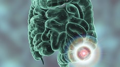 People With Diabetes Have a Higher Risk of Colon Cancer: Study