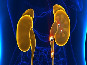 Watching Feasible for Asymptomatic Kidney Stones