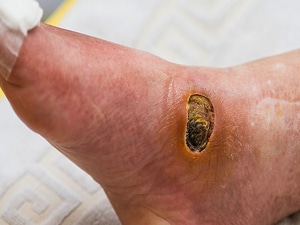 Foot Ulcers Red Flag for Eye Disease in Diabetes