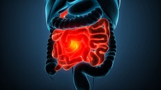 How BMI Over Time Impacts GI Cancer Risk