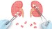 SCAI Drafts Guidance on Renal Denervation for Hypertension