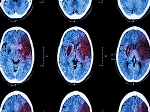 More Support for Thrombectomy in Large Core Stroke