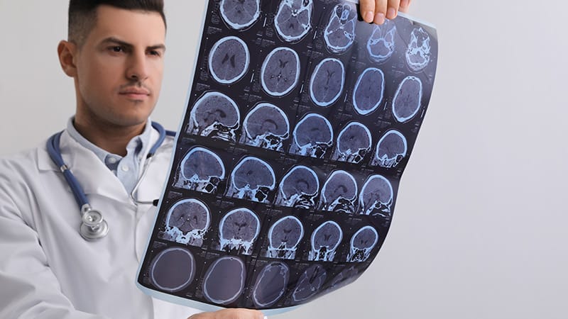 Multiple Sclerosis Medscape , New Consensus Guideline on Clinical MRI ...