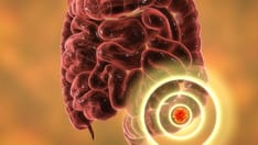 Was the Fruquintinib Trial for Metastatic CRC a Win?