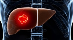 Liver Cancer Causes Differ Markedly by Race/Ethnicity