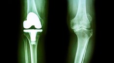 Does Continuity of Care Affect Outcomes After Arthroplasty?