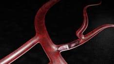 Fast Five Quiz: Thromboembolism