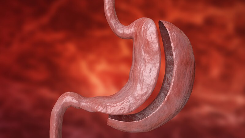 Minimally Invasive Gastrointestinal Surgery | Medscape