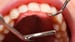 Not So Fast on Dental Screenings in Primary Care, USPSTF Says
