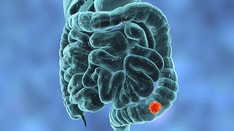 Jury Still Out on Whether Green Tea Lowers Colon Cancer Risk