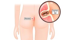 Pilonidal Disease: Study Finds Laser Hair Removal Beneficial