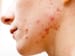 Acne Can Be More Distressing Than Melanoma