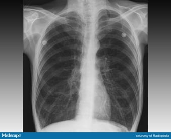 More Diagnostic Errors In Patients With Pulmonary Symptoms