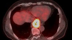 Gastric Cancer e-Tumor Boards: Case 2: Gastroesophageal Junction Adenocarcinoma