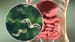 Antibiotic Linked to Rise in Early-Onset Colon Cancer?