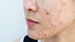 Topical Antioxidants With Laser May Prevent Acne Scars
