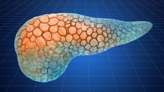 Artificial Pancreas Tried in Patients With Type 2 Diabetes on Dialysis