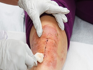 Knee Arthroscopy Timing May Complicate Total Knee Arthroplasty